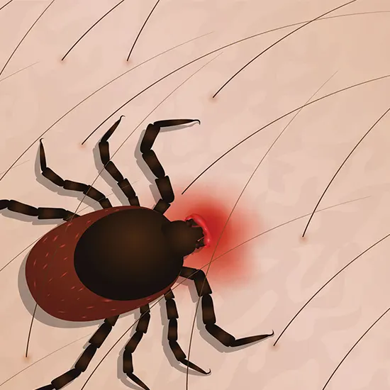 crimean congo haemorrhagic fever